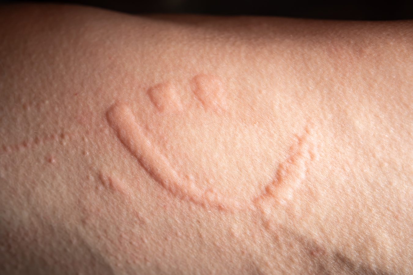 Dermatographia