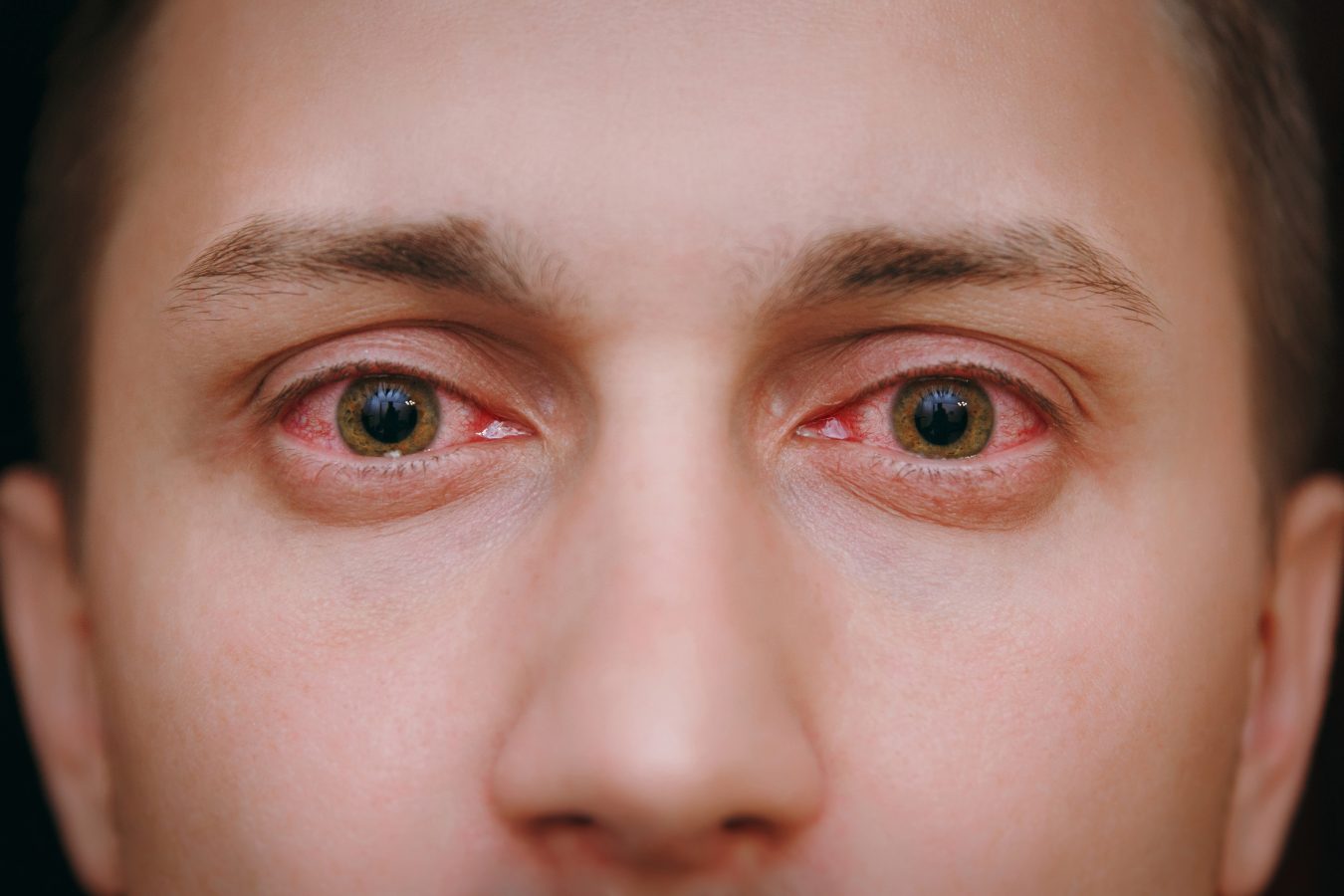 Conjunctivitis