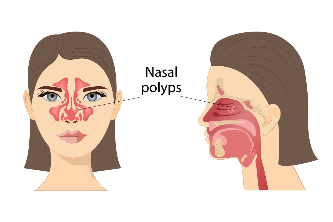 Nasal polyps1