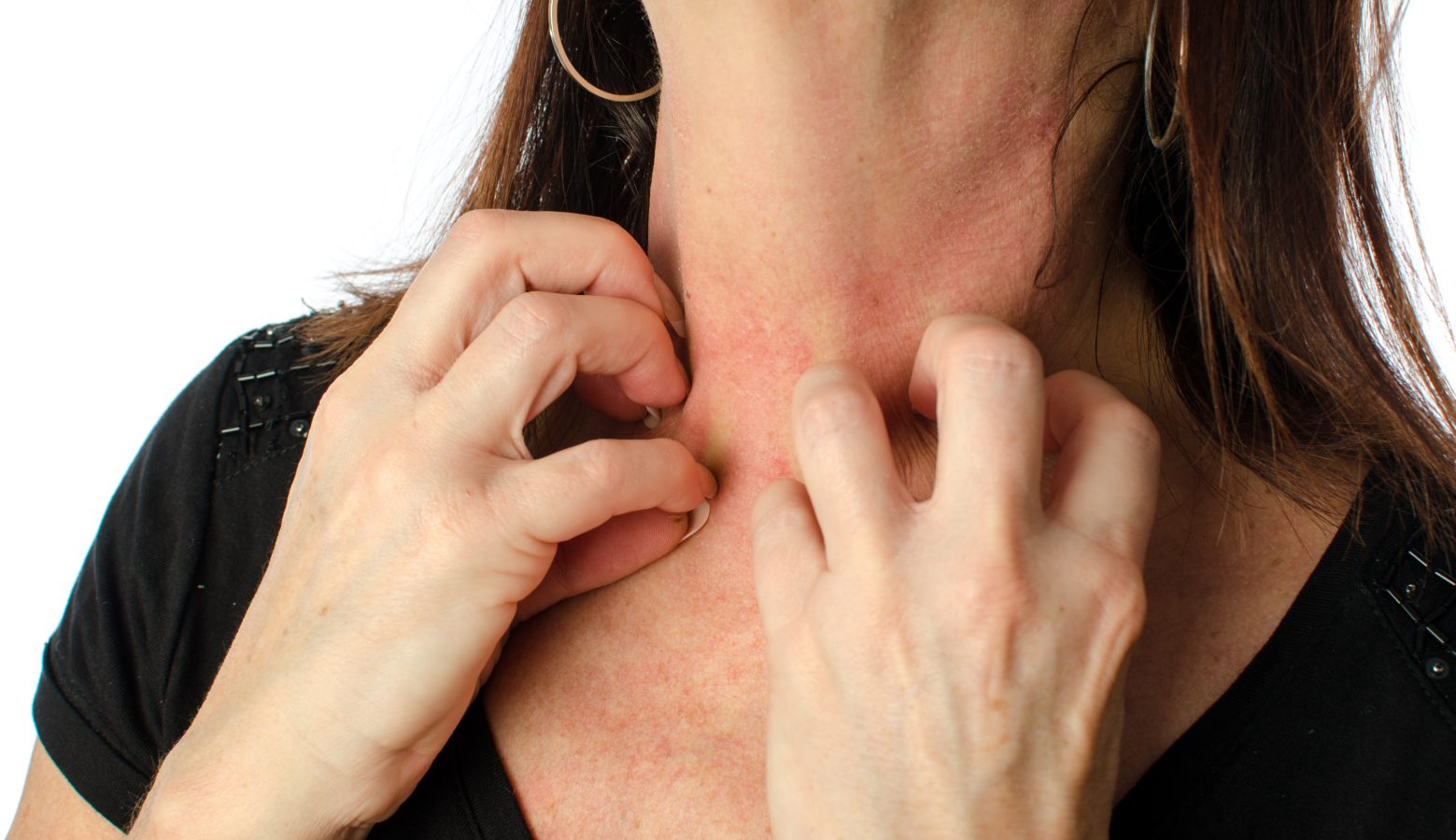 contact dermatitis contact allergy neck rash perfume allergy 2